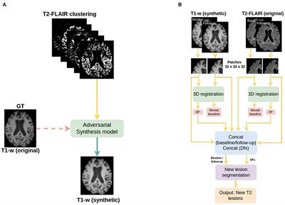 Evaluating the use of synthetic T1-w images in new T2 lesion detection in multiple sclerosis